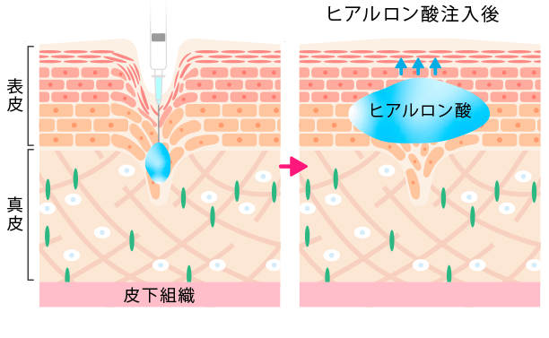 ヒアルロン酸注入