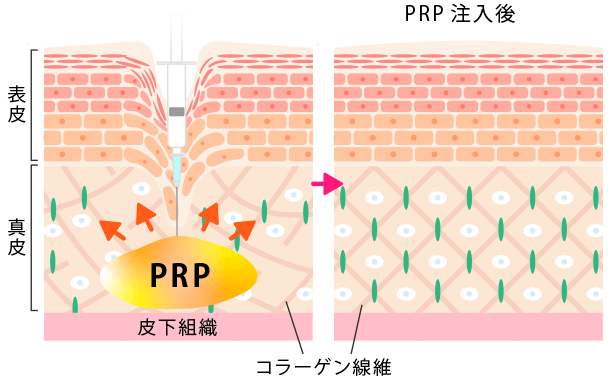 高濃度プレミアムPRP