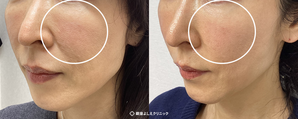 肌の再生医療(線維芽細胞治療)