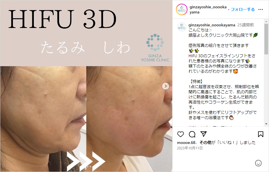 銀座よしえクリニックのInstagram HIFU 3D