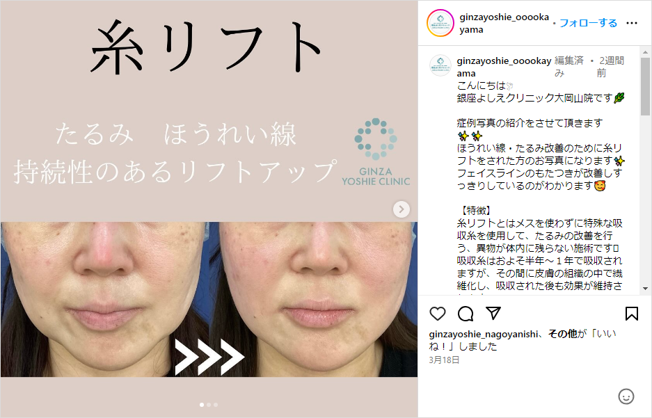 銀座よしえクリニックのInstagram 糸リフト