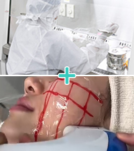 CPC頬再生ハイフプラス