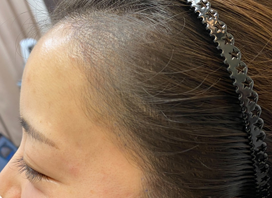 アートメイク(ヘアライン・生え際)