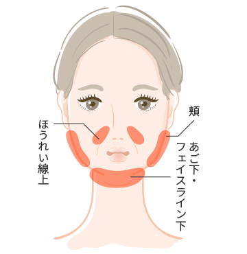 BNLS注射は打ち方と打つ量で効果が違います