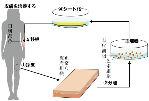 メラノサイトを保持した培養表皮移植