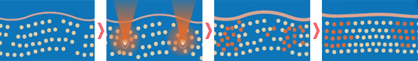 美容治療に用いるHIFU（ハイフ）のメカニズム