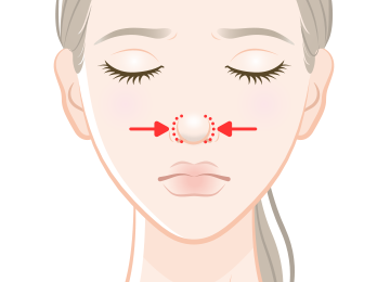 団子鼻解消、鼻翼縮小の場合