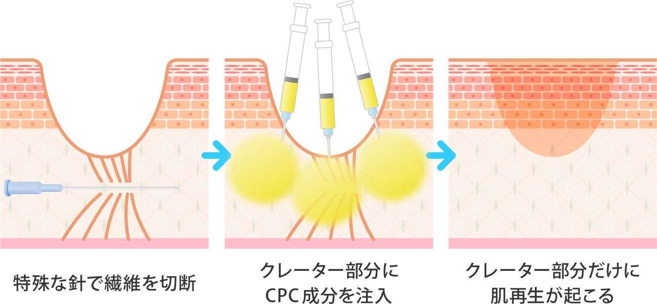 サブシジョンとCPCのコンビネーション治療