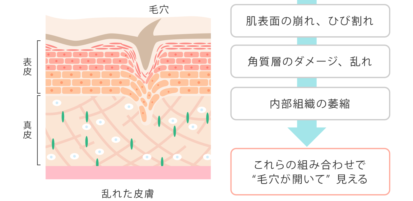 たるみ毛穴の原因