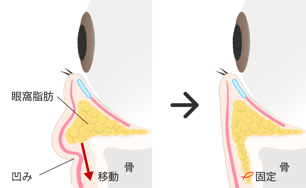 裏ハムラ法(経結膜的眼窩脂肪移動術)施術方法