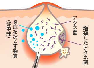 アクネ菌が増殖する