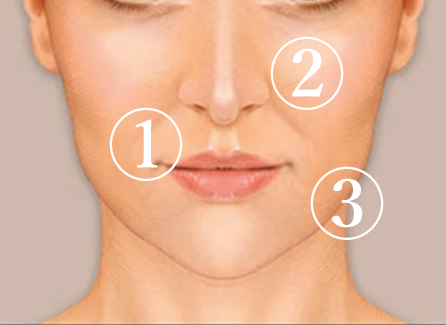 「ほうれい線・頬のたるみ」即効型解消治療