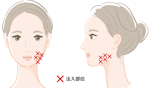エラ縮小注射の施術部位