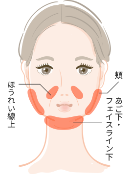 BNLS注射の打ち方と打つ量