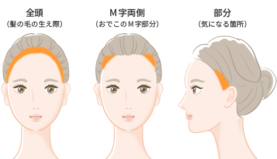生え際のデザイン