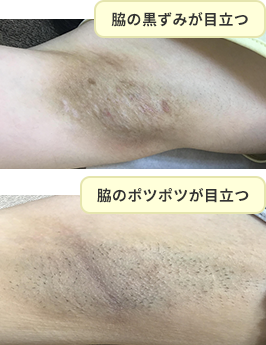 脇の黒ずみが目立つ 脇のポツポツが目立つ 症例写真