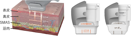 ハイフシャワーは真皮層1.5㎜～2㎜にアプローチ