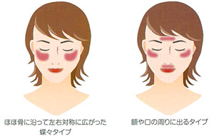 肝斑の特徴例