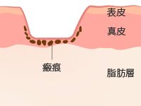 ボックス型クレーター