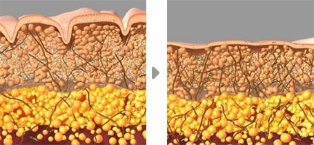 トライポーラによる肌の引き締め断面図
