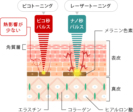 レーザートーニングとピコトーニングの違い