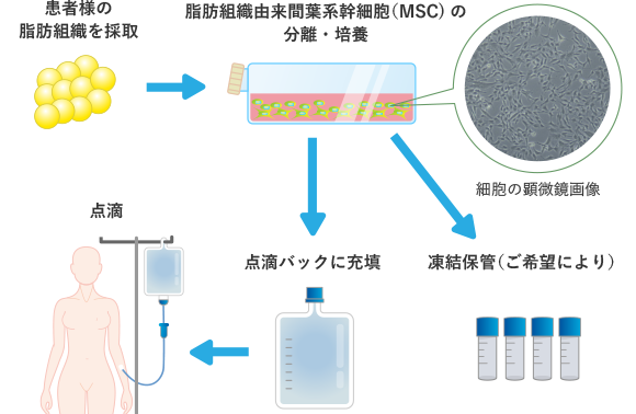 自己脂肪組織由来間葉系幹細胞治療の流れ