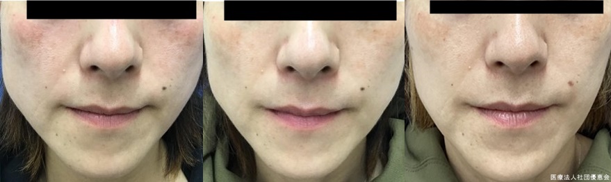 小顔ボト注射　１回 施術前/2週間後/3ヶ月後