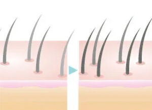 白髪・脱毛症改善治療（白髪注射・髪を太くする注射）
