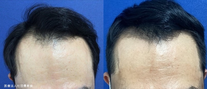 CPC毛髪再生プラス10回（2クール）+内服・ミノキシジルオプション 施術前 / 2クール施術後