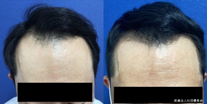 CPC毛髪再生プラス10回（2クール）+ミノキシジルオプション 施術前 / 2クール施術後