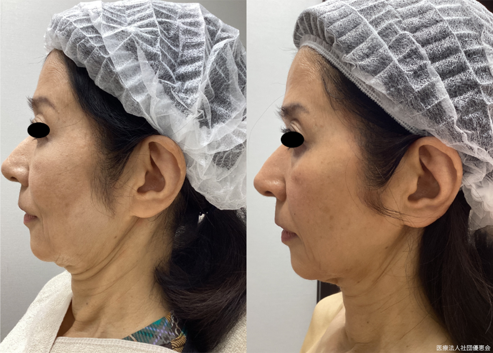 ボトックスリフト1回 60代女性 施術前 / 4ヵ月後