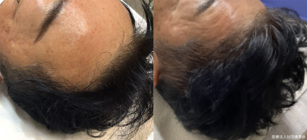 CPC毛髪再生プラス　4クール（20回） 施術前 / 20回施術後