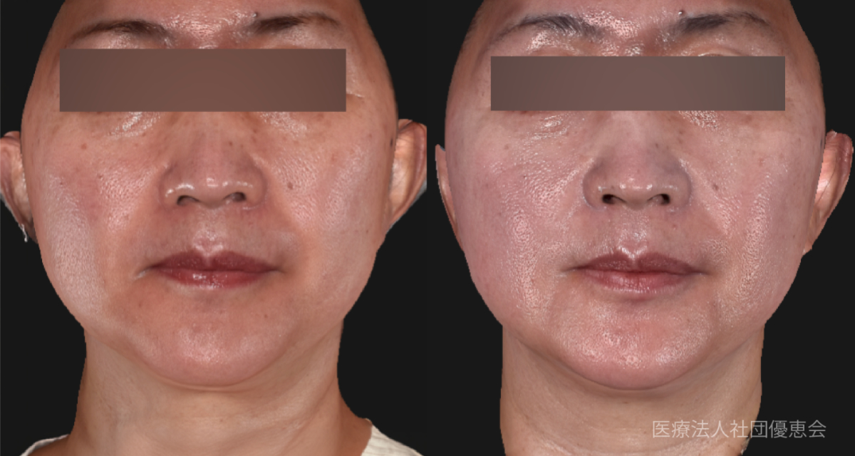 PrimeX(全顔)1回 50代女性 施術前 / 施術後