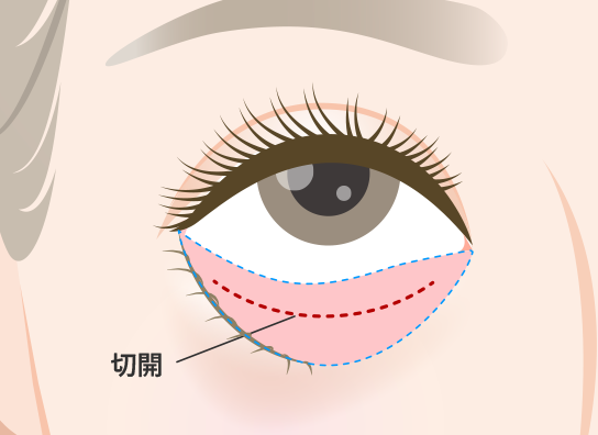 裏ハムラ法