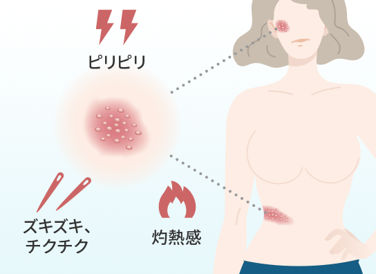 帯状疱疹後神経痛治療の特徴