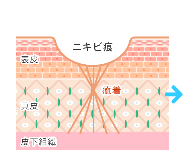 皮膚組織が癒着して固くなりクレーター状になる